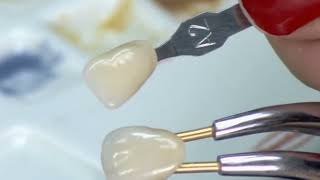 CO CR MK1 Precision Attachment Denture Corrosion Resistance