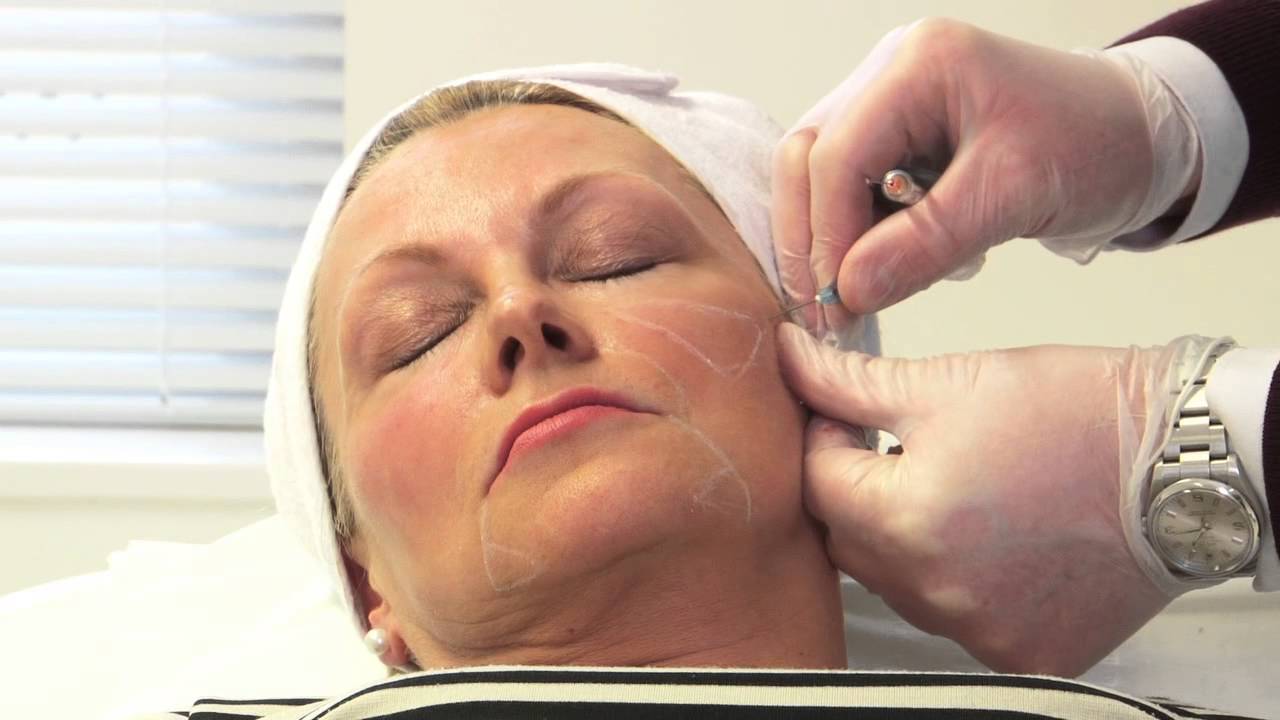 Facial rejuvenation with dermal fillers