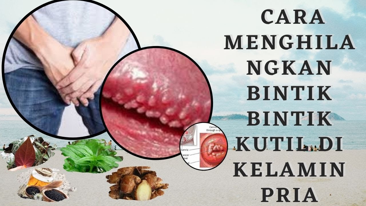 Cara Menghilangkan Bintik Bintik Kutil Di Kelamin Pria ...