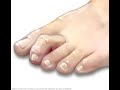 How to treat hammer toes without surgery | Benjamin Marble DPM
