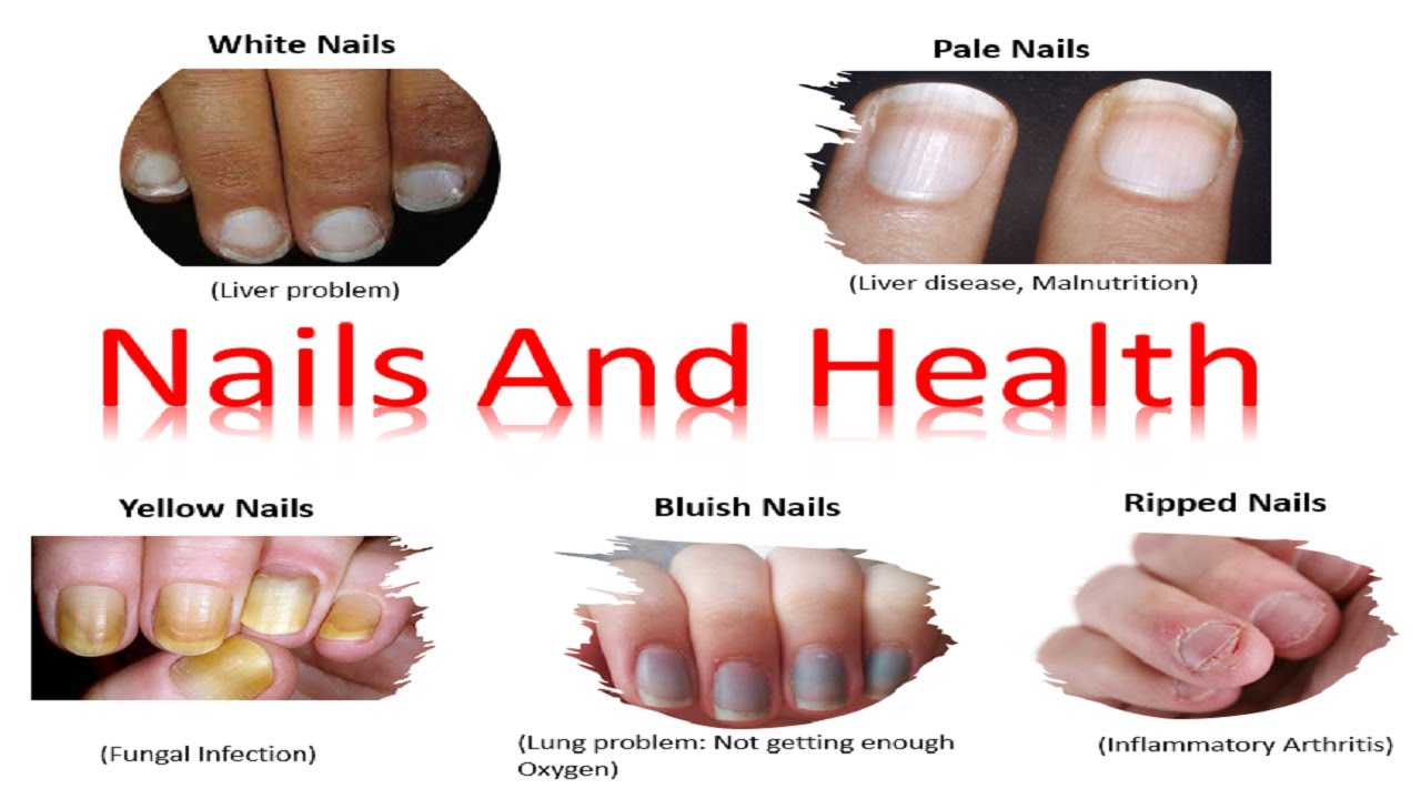 8. The Role of Genetics in Nail Color and Health - wide 1