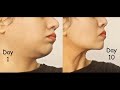 از بین بردن غبغب و زاویه دار کردن چانه در 10 از بین بردن غبغب و زاویه دار کردن چانه در 10