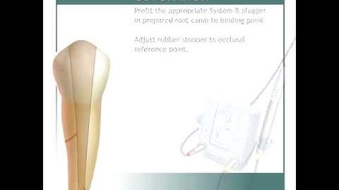 Continuous Wave Of Condensation Elements Obturation System