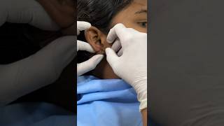 Ear piercing after ear reconstruction surgery