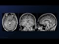 Midline scit approach for resection of a quadrigeminal midbrain cavernous malformation