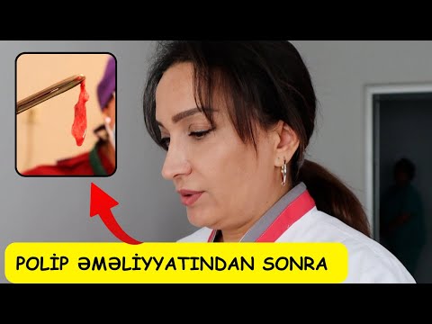 Polip Əməliyyatından SONRA - Həkimin Dedikləri