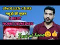 मसूड़ो की सूजन 5 घरेलू इलाज | 5 Best Home remedies for swollen gums