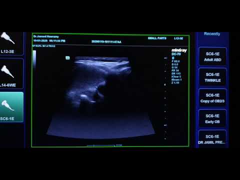 Branchial Cleft Cyst Ultrasound