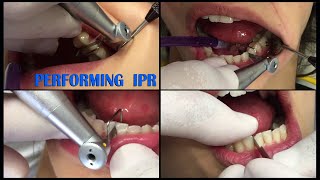 IPR in Invisalign therapy: How it is done