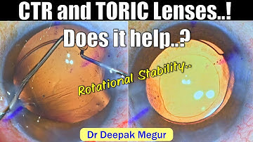 Use of CTR in Toric IOLs, Does it help..? Phacoemulsification in eye with Pathological myopia.