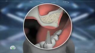 2  Новое в стоматологии.  Зубные импланты правда и вымысел