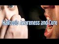 Halitosis awareness and cure