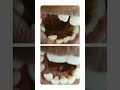 Shorts youtubeshorts teethcleaning teeth cleaning transformation