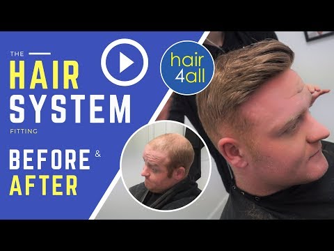 Before & After | Hair System | Non-Surgical Hair Replacement System for Men/Women | UK/USA/INTL