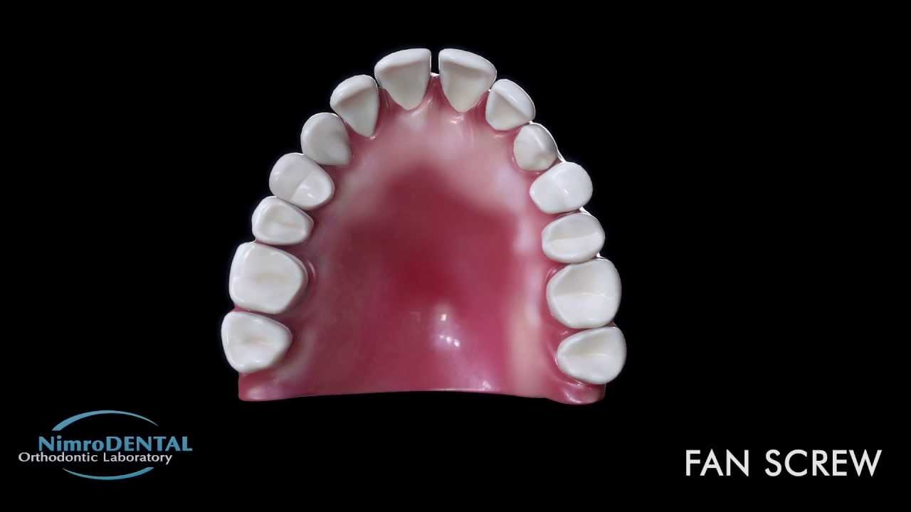 Fan Screw Orthodontic Expansion Appliance Demo YouTube