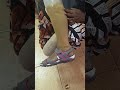 Poor Quality Prosthetic Leg
