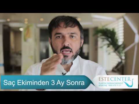 Saç Ekiminden 3