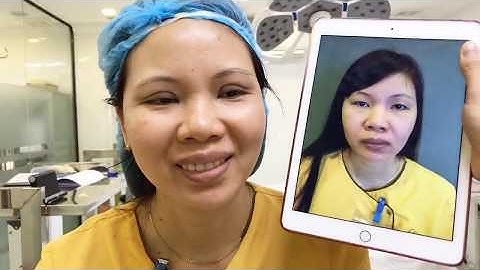 Mí Đẹp Đều Sau 30 Phút Cắt Mí Mani Mini Deep 5D.