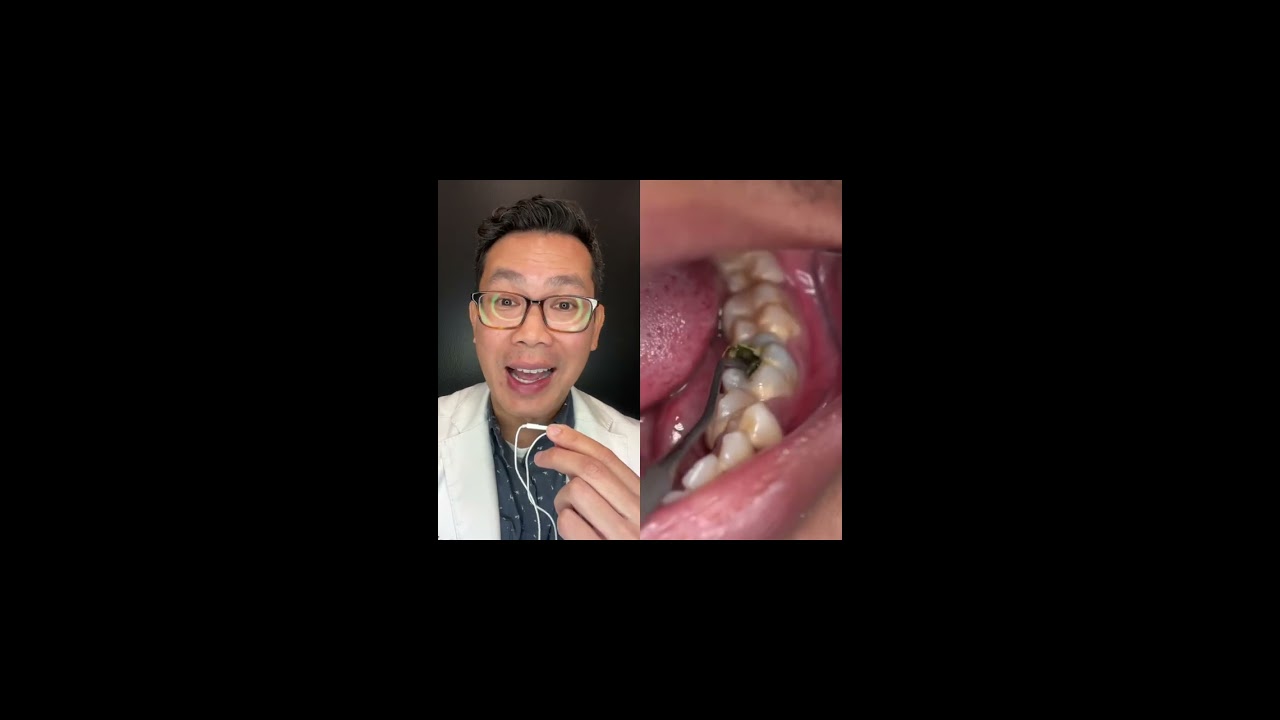 What Is This Hole In Person Tooth 