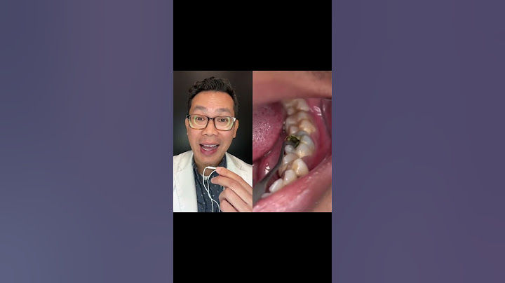What is this Hole in this Person Tooth?