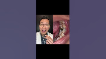 Thumbnail of What is this Hole in this Person Tooth?