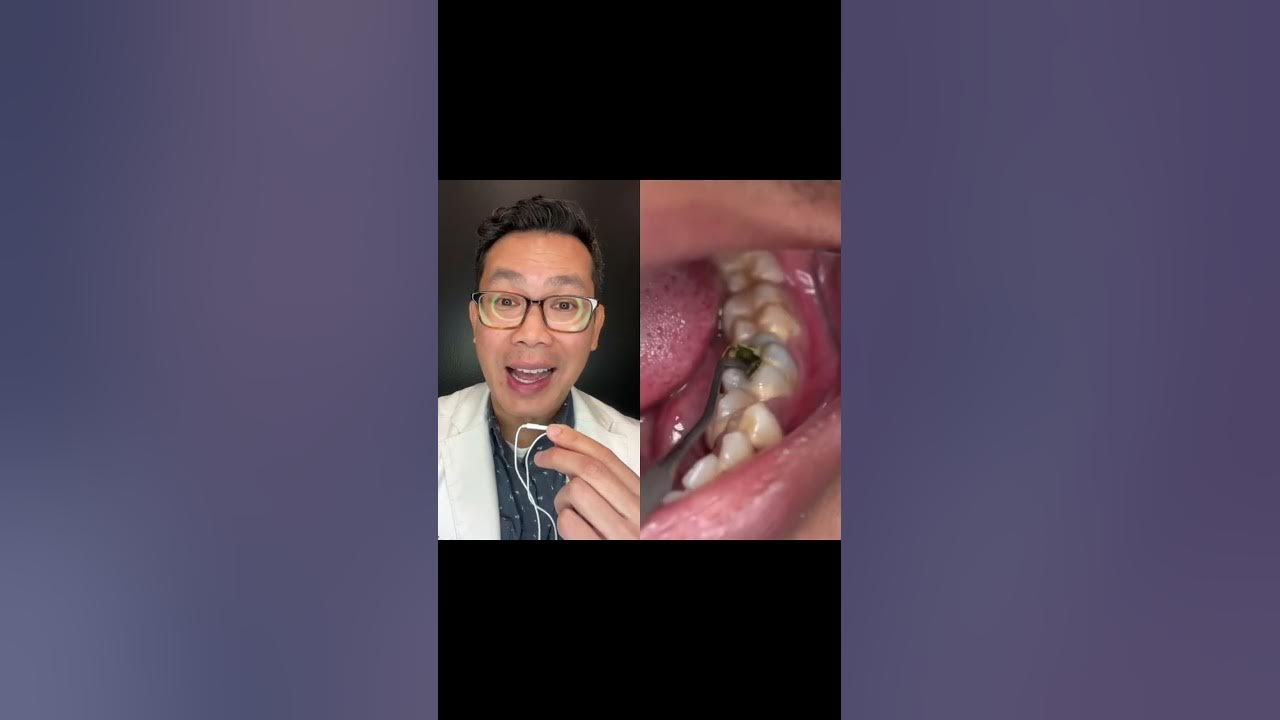 What is this Hole in this Person Tooth?