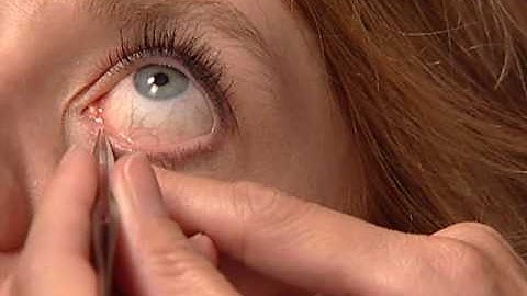 Removal of the Parasol Punctal Plug