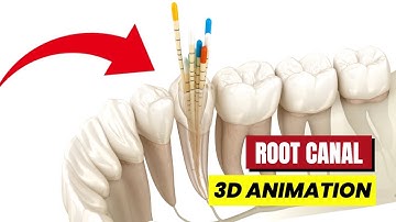 How Dentists Perform Root Canals  Complete 3D Animation Guide What Really Happens Inside Your Infect