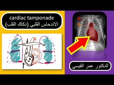 (الدكاك القلبي (انحسار القلب │cardiac tamponade اسبابه اعراضه وكيفية علاجه