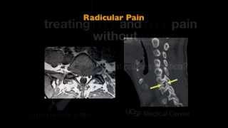 UCSF Radiology: What causes sciatica?