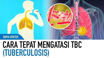 Penanganan TBC Yang Tepat Dan Cepat Berdasarkan Saran Dokter | Kata Dokter