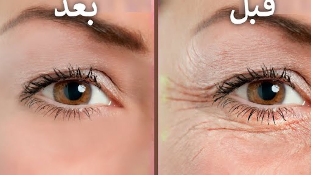 اسعار حقن البوتكس