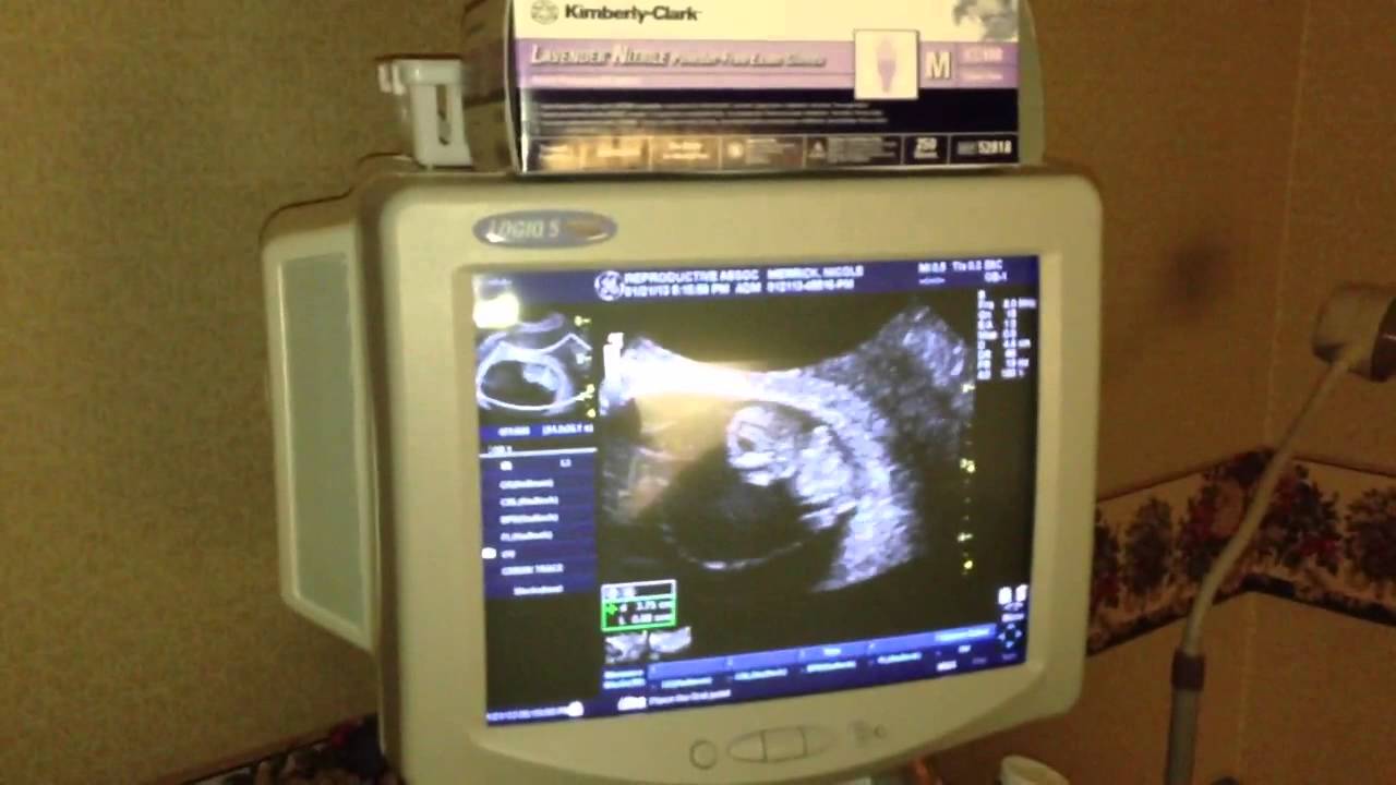 Ultrasound #4: 8 weeks 6 days part 2 - YouTube