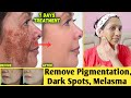 कितने भी मुश्किल झाइयाँ Hyperpigmentation Melasma काले धब्बे Spots हो, इस Remedy से होगा 100% इलाज |