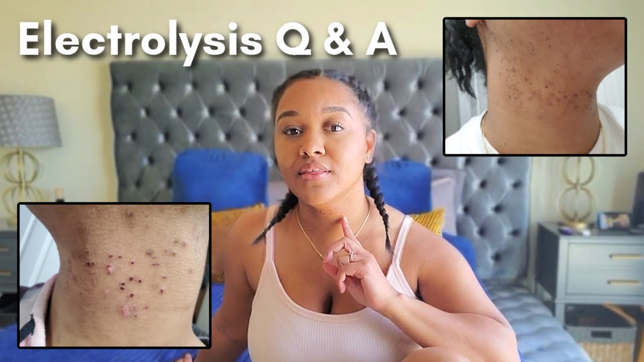 Electrolysis Hair Removal Q&A !!! - YouTube