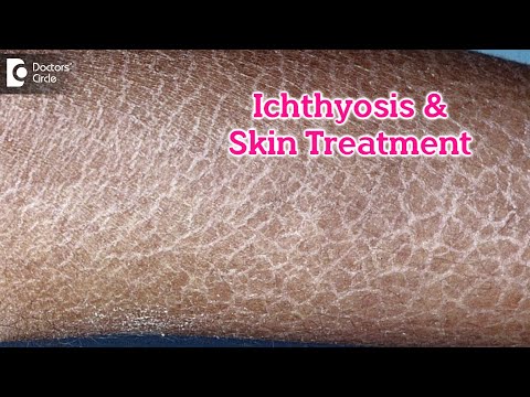 What is Ichthyosis? How to Treat my Skin?| Fish like scales On Skin-Dr.Rasya Dixit | Doctors&rsquo; Circle