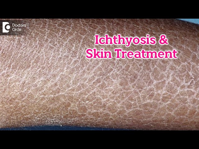 What is Ichthyosis? How to Treat my Skin?, Fish like scales On  Skin-Dr.Rasya Dixit