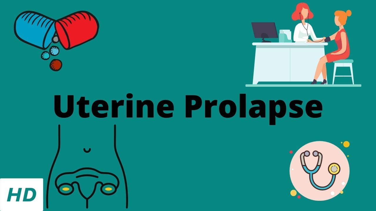 Uterine Prolapse Causes Signs And Symptoms Diagnosis And Treatment