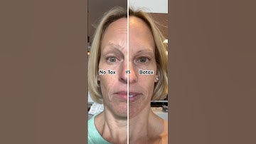 Botox vs No Tox: Before and after Botox injections 💉