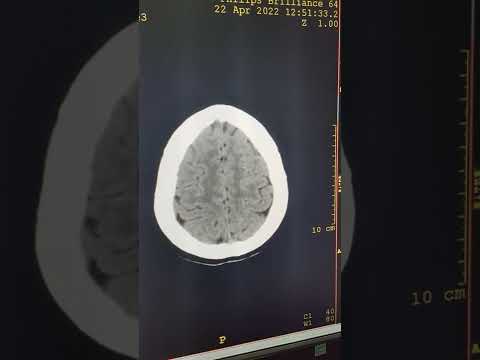 اشعة المفراس لشخص سليم