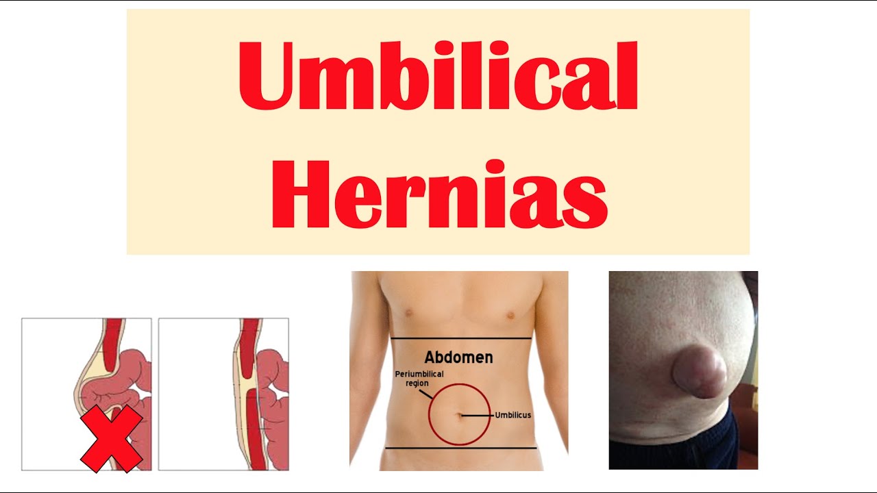 Types of Hernia in Adults