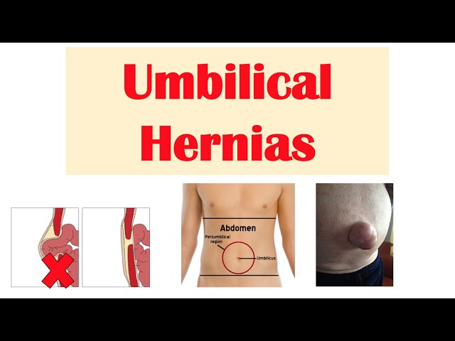 Umbilical hernia in adults and other Related Problems