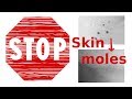 How to Get Rid of a Skin Mole at Home Fast &amp; Naturally
