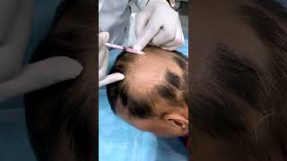 Alopecia Areata Treatment  | Prevent Patchy Hair Loss | Skinaa Clinic skinaaskincare shorts