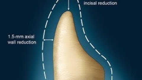 Hướng dẫn mài cùi răng cửa