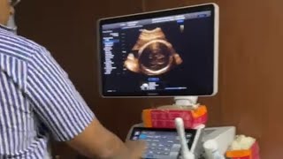 36 Weeks Pregnant Wellbeing Scan 2