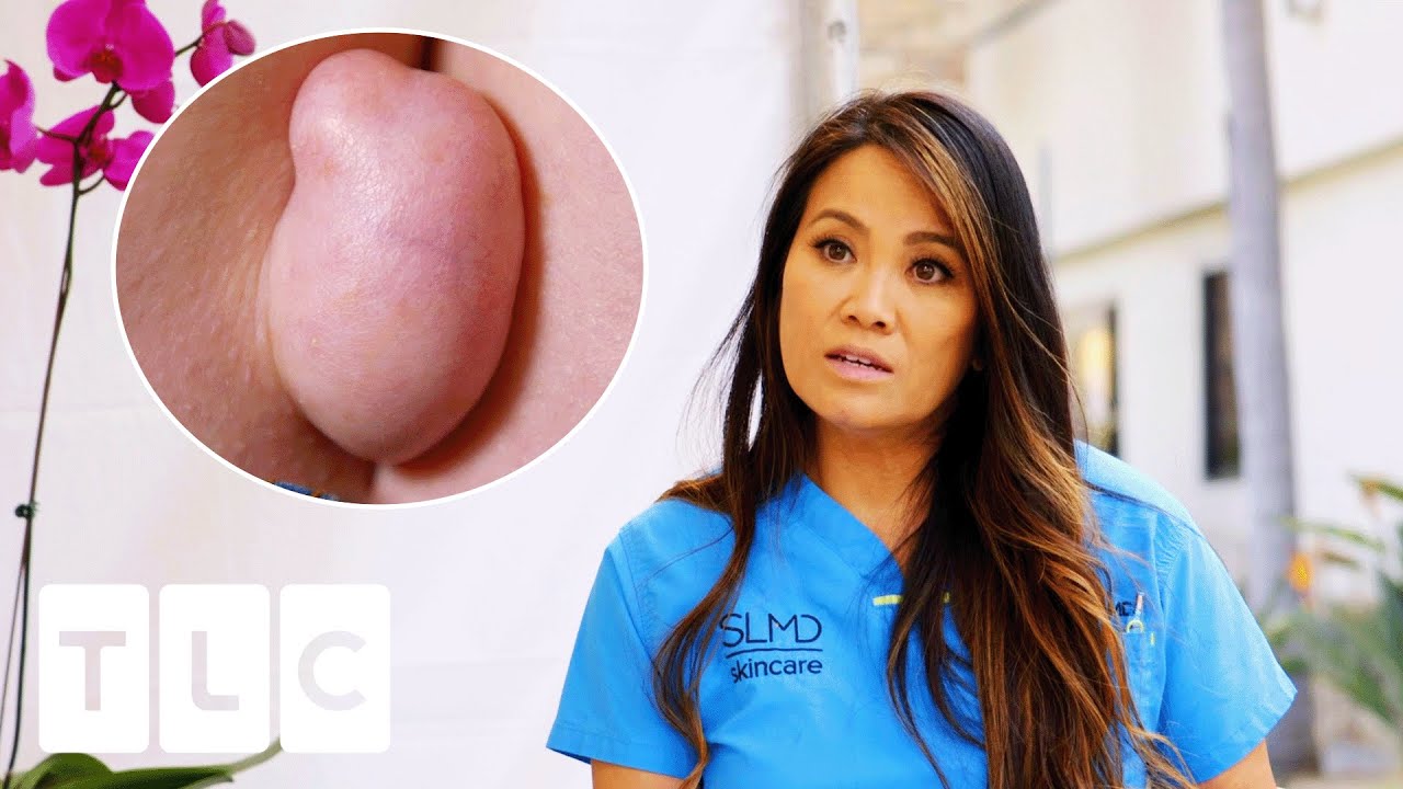 Dr Lee Removes A Groth From Women's Bottom | Dr Pimple Popper: This Is Zit | CENSORED