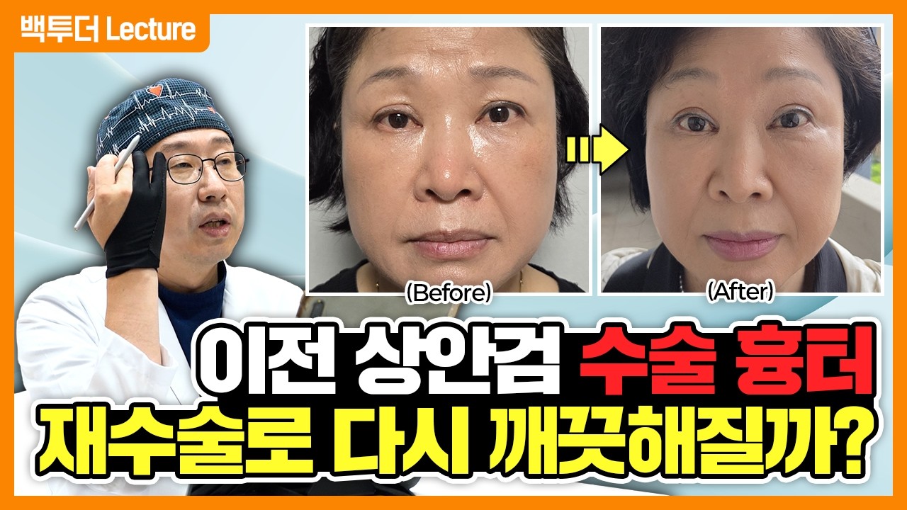 눈 감으면 찝힌 흉터, 뜨면 짝눈… 오래된 쌍꺼풀 재수술 1~6개월 변화 과정