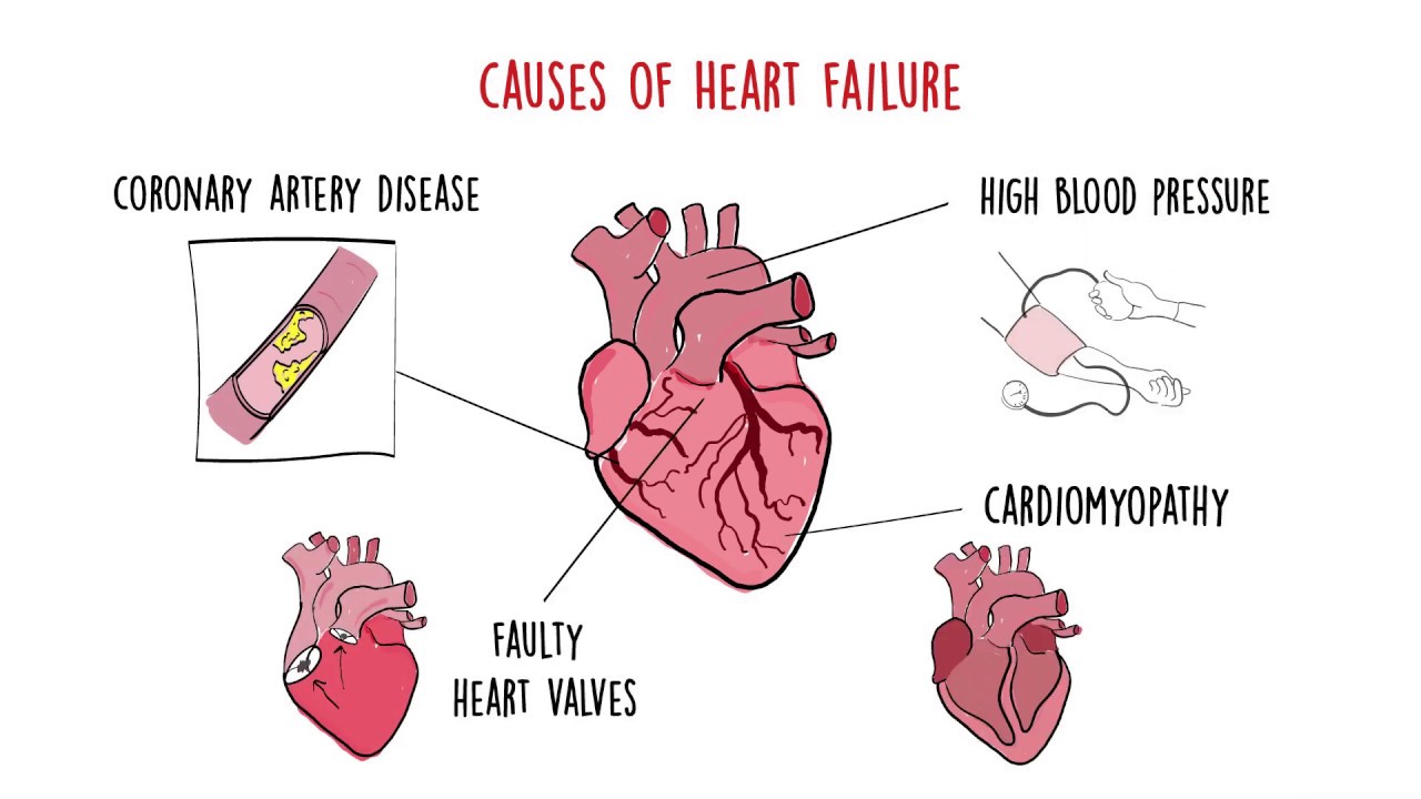 Heart Failure - CVD Roadmaps