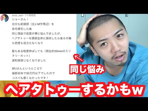 自毛植毛日記第23弾 週間目から21週間目までの経過 Youtube